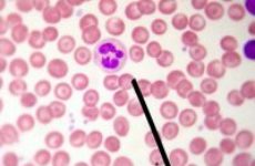 Причины повышения лейкоцитов в крови