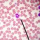 Причины повышения лейкоцитов в крови