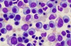 Наличие плазматических клеток в общем анализе крови