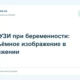 4D-УЗИ при беременности: объёмное изображение в движении