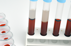 Клинический анализ сыворотки крови: интерпретация биохимических параметров