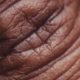 Вирусные инфекции кожи: диагностика и лечение